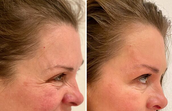 Botox to Crow's Feet