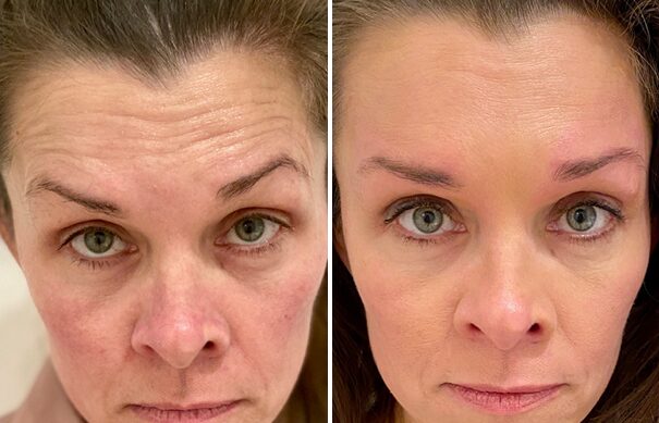 Botox to Forehead