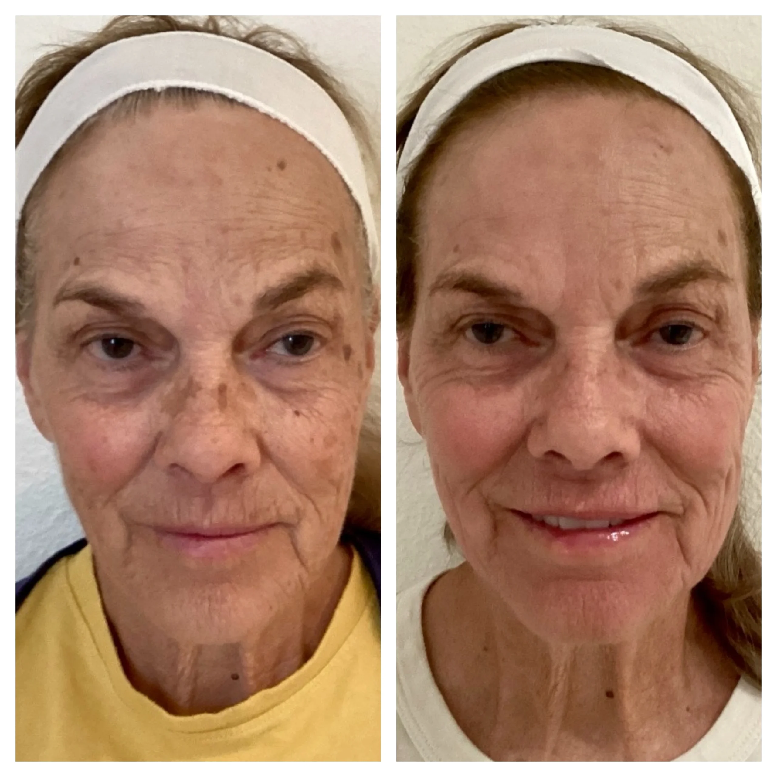 LASERS+LIGHTS_ IPL PHOTOFACIAL