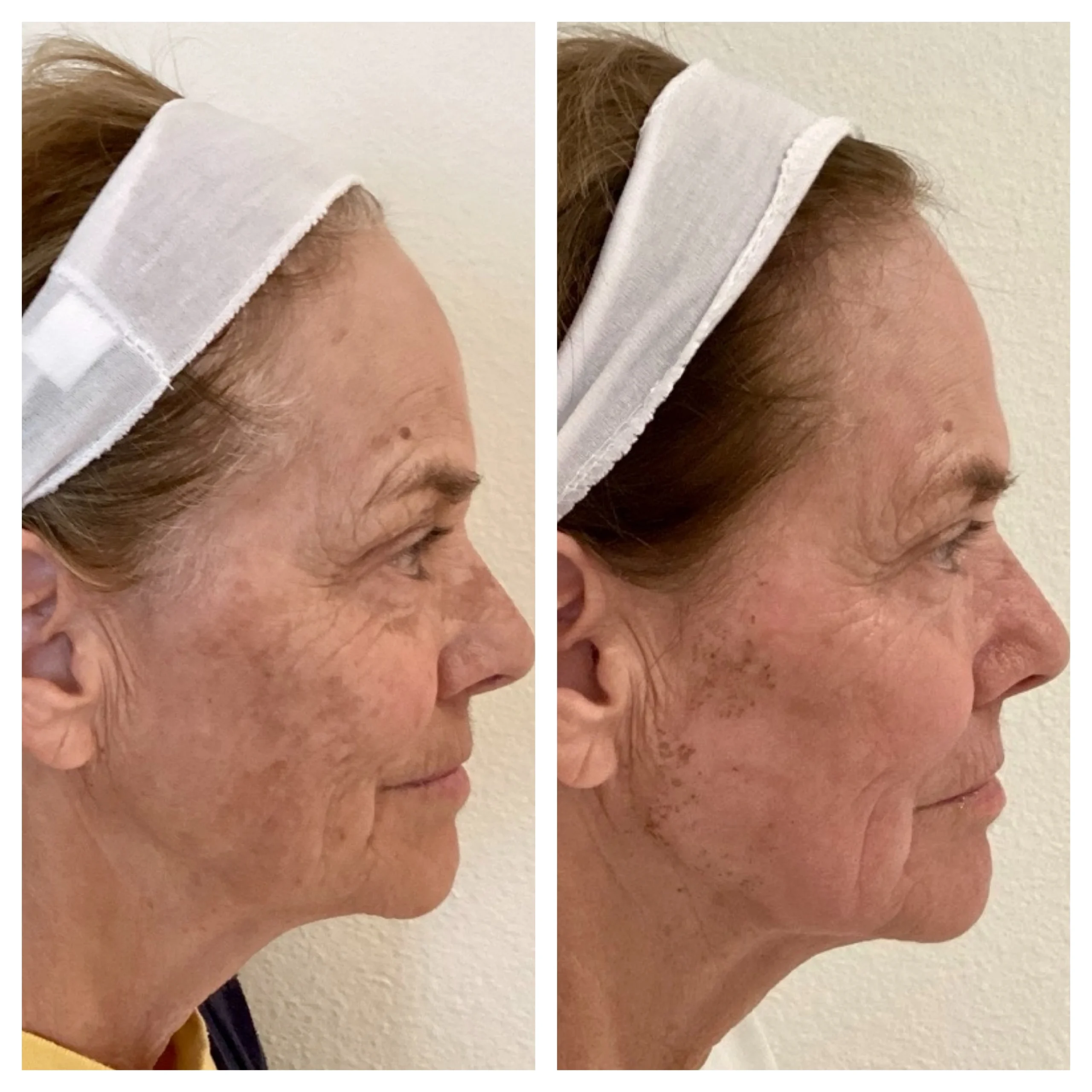 LASERS+LIGHTS_ IPL PHOTOFACIAL