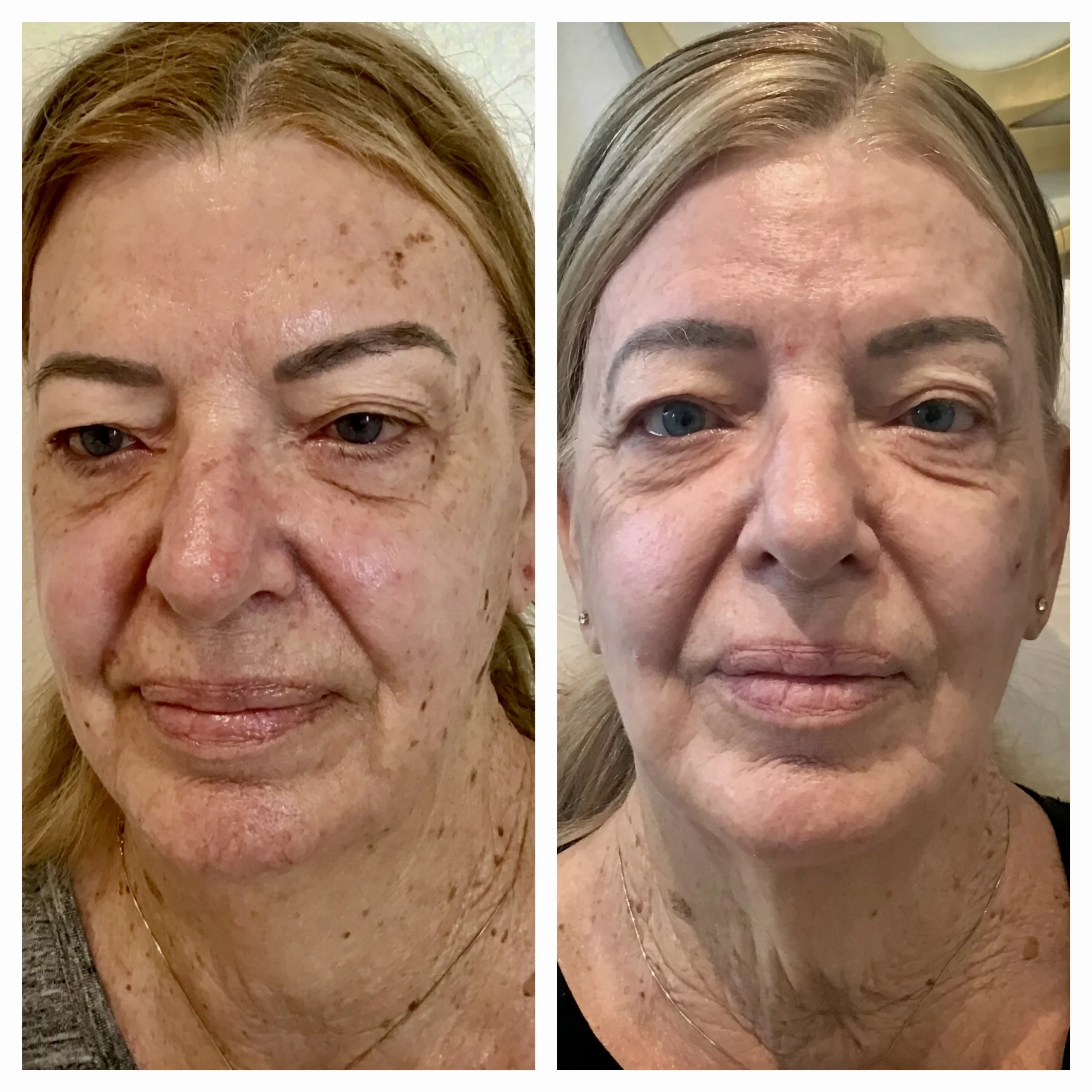 LASERS+LIGHTS_ IPL PHOTOFACIAL