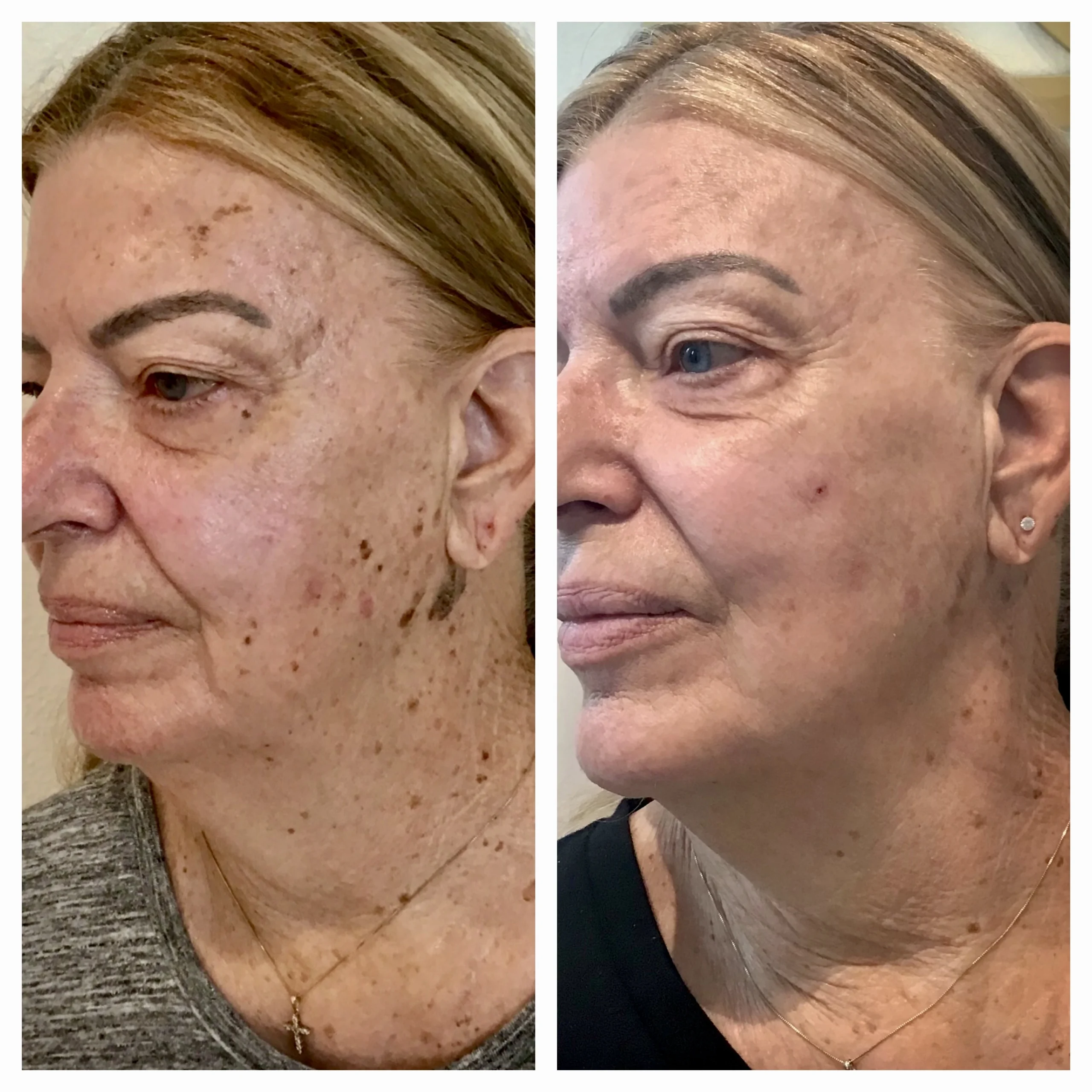 LASERS+LIGHTS_ IPL PHOTOFACIAL