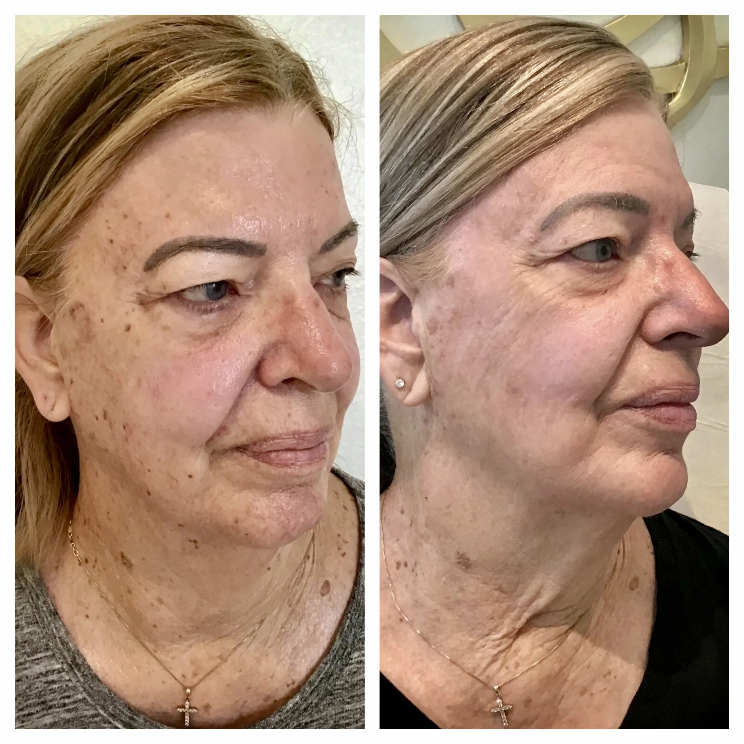 LASERS+LIGHTS_ IPL PHOTOFACIAL