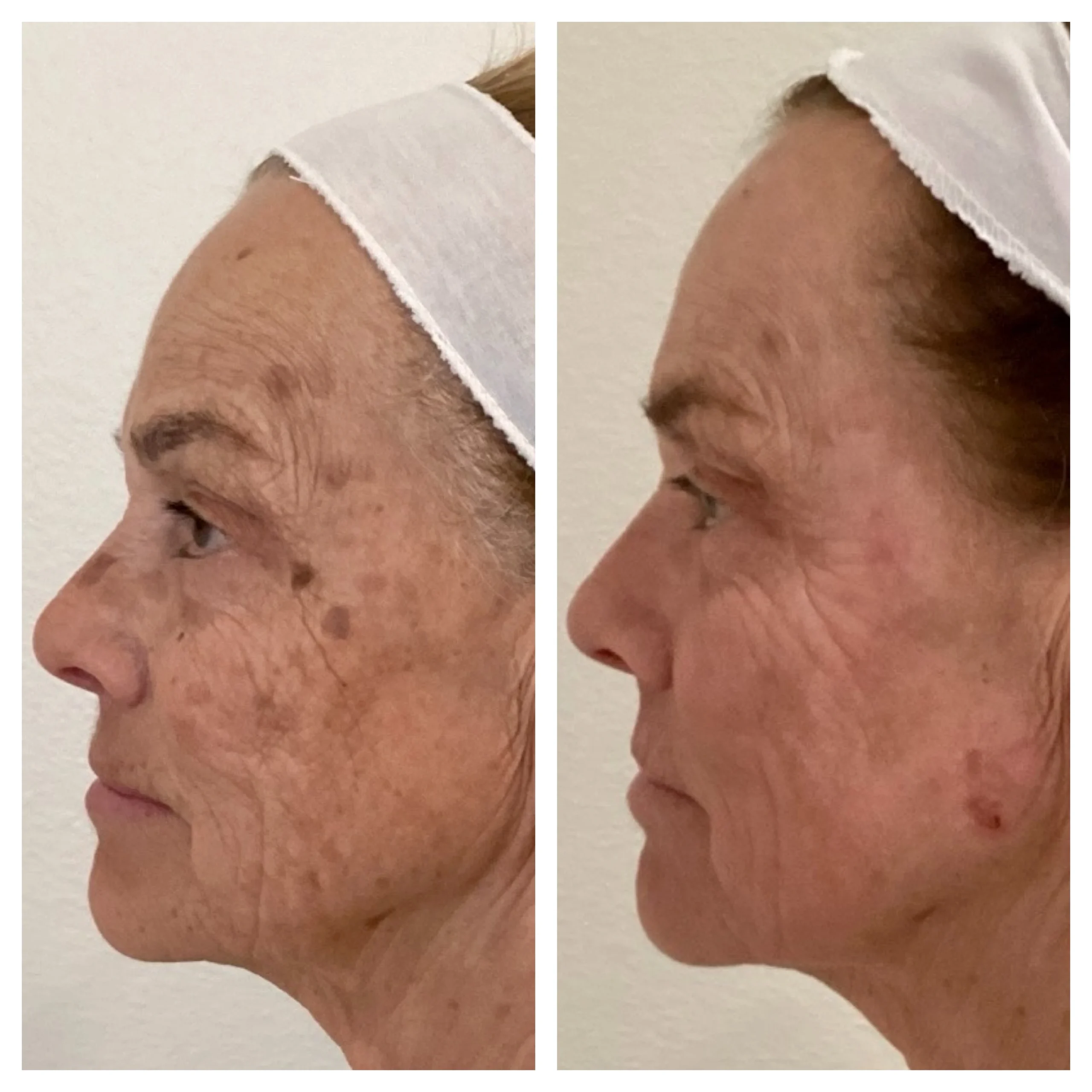 LASERS+LIGHTS_ IPL PHOTOFACIAL