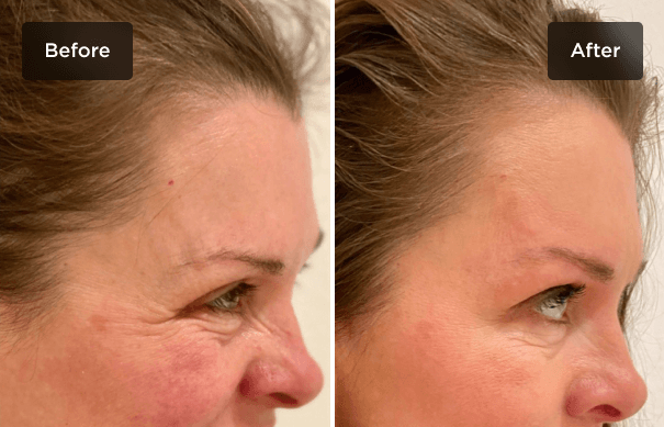 Botox-to-Crows-Feet