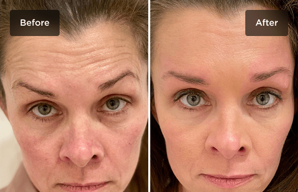 Botox-to-Forehead