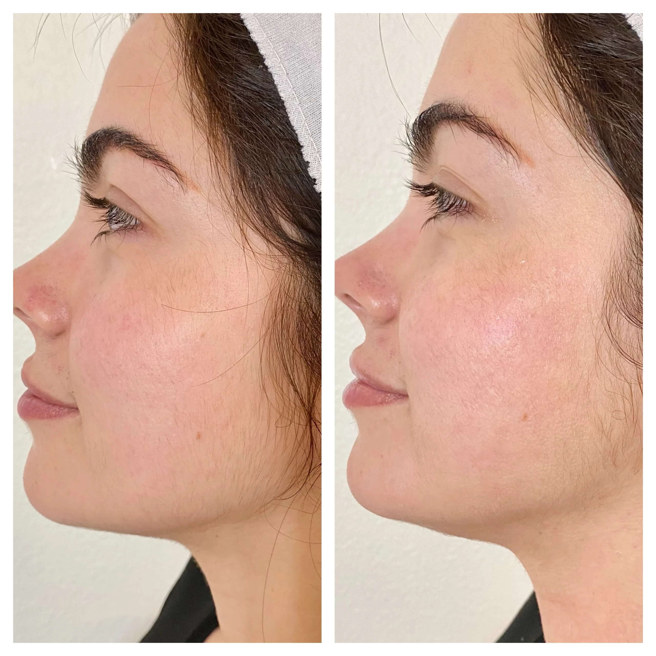 SKIN REJUVENATION_ SKIN STYLUS MICRONEEDLING WITH ARIESSENCE PDGF