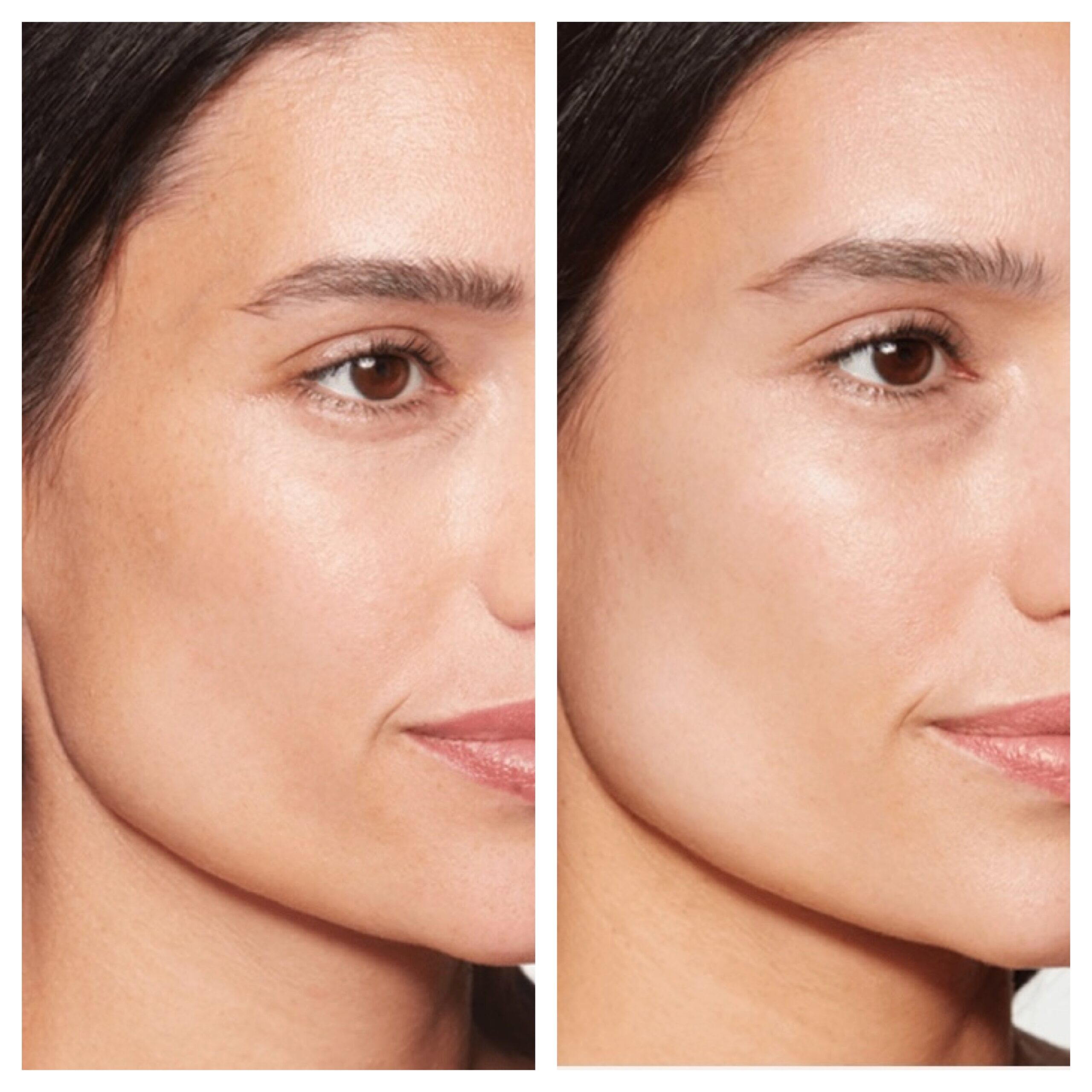Sculptra | 3 Vials